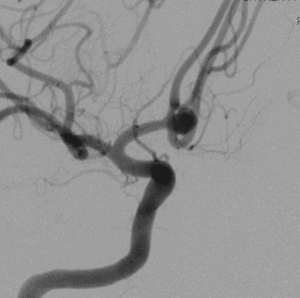 Dr. Hellinger provides first WEB treatment for cerebral aneurysm