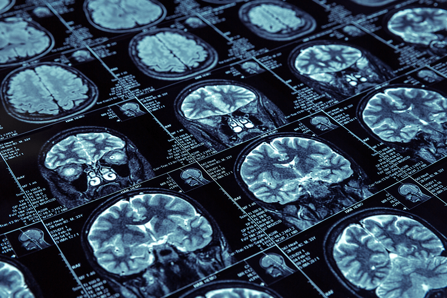 Brain scans are used to guide neurosurgery treatment