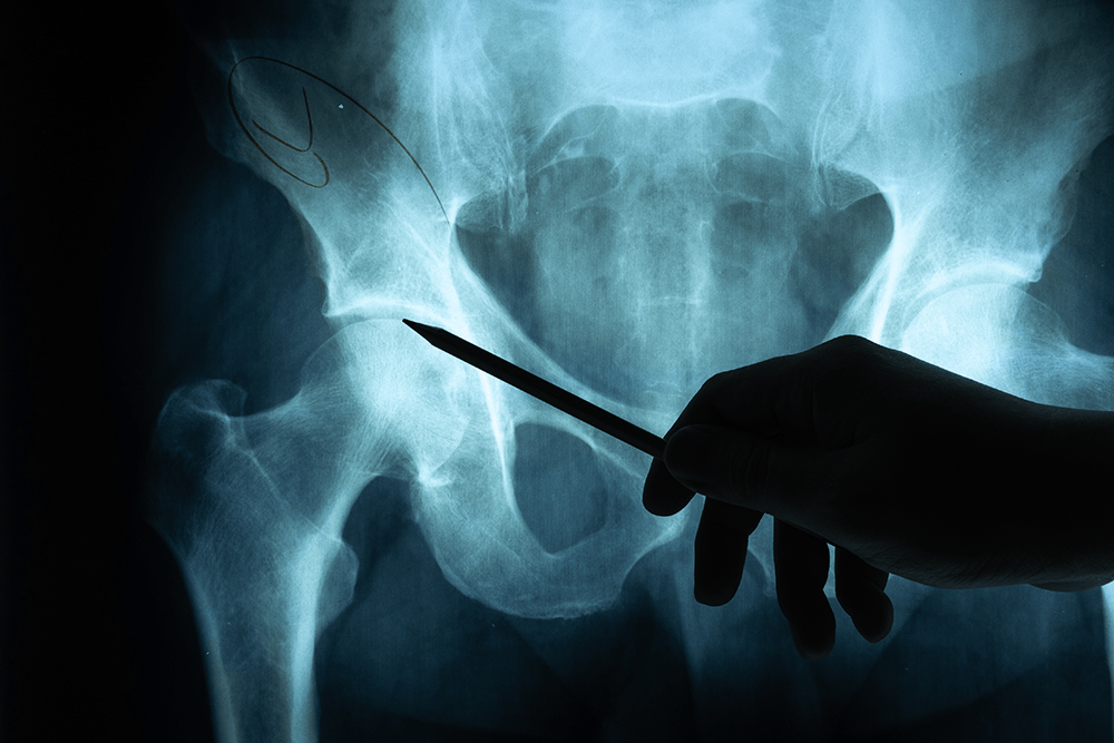 Specialist identifies on x-ray where SI joint fusion will be performed.