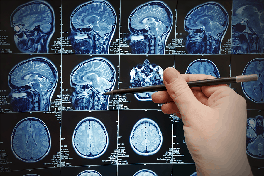 Specialist examines CT scan for brain tumors