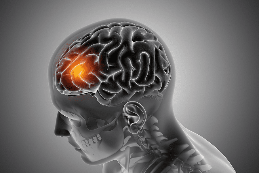 A 3D image of the brain with the area highlighted where Glioblastomas are known to develop.