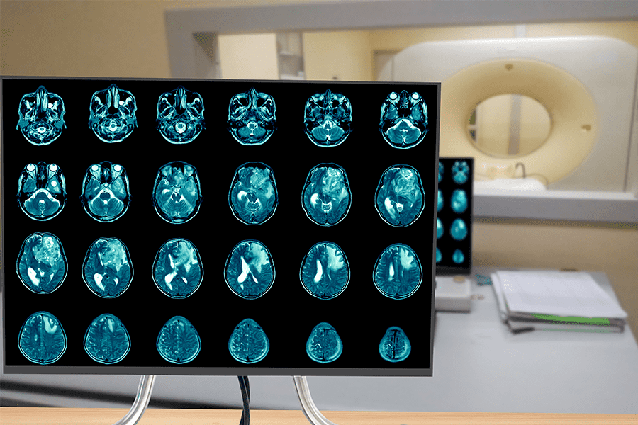 Image of a brain scan where a Glioblastoma is suspected in the patient.